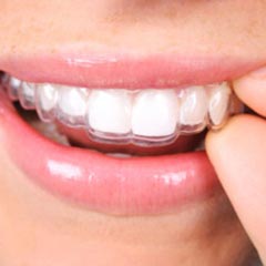 Invisalign