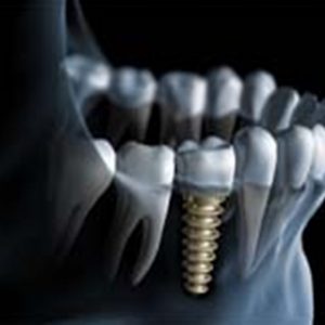 Implant Dentistry